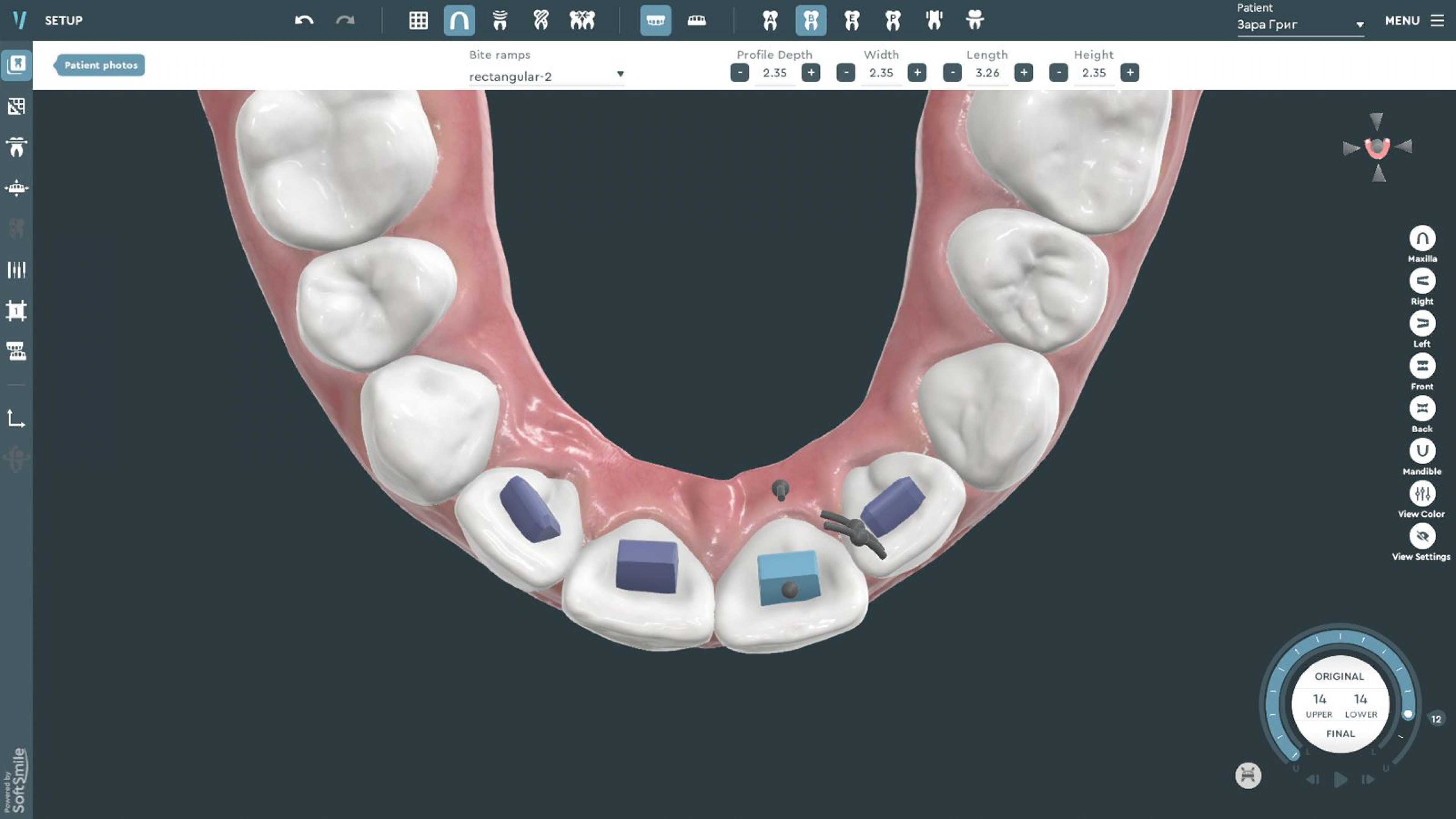 Vision Clear Aligner Treatment Planning